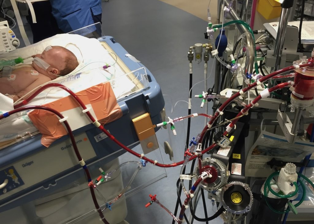 ECMO equipment beside Sophie's cot